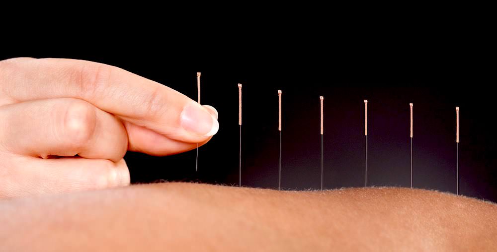 Acupuncture